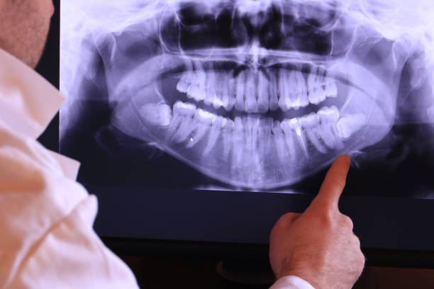Best Dental Abscess Treatment in Livingston, MT